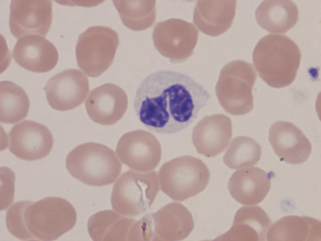 PB dysplastic neutrophil 200x